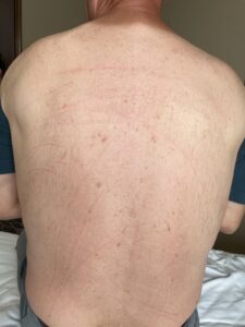 Back Acne after laser acne treatments from Laser Beamer Skincare