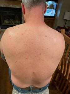 Back Acne before laser acne treatments