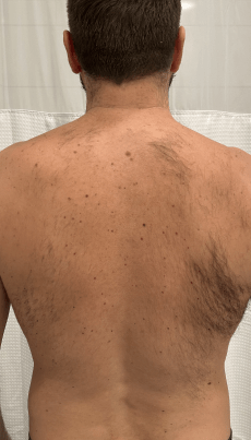 Back hair removal after one laser hair removal session on the left side