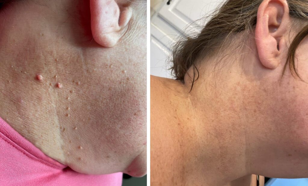 Laser Beamer Skincare Skin Tag Removal before and after success story
