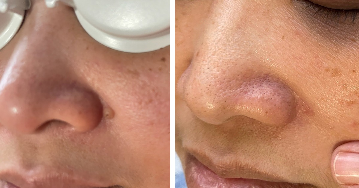 Nasal Pearl Before and After Success Story