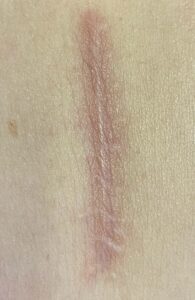 Scar 1 Week After Laser Treatment for Scar Reduction