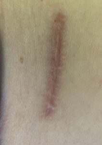 Scar before laser treatment for scar reduction