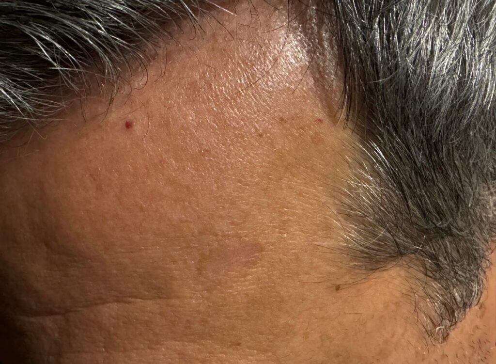 seborrheic keratosis succeessfully removed after two laser treatments and twenty days