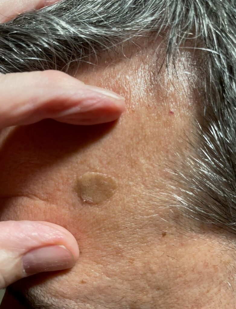seborrheic keratosis before laser treatment