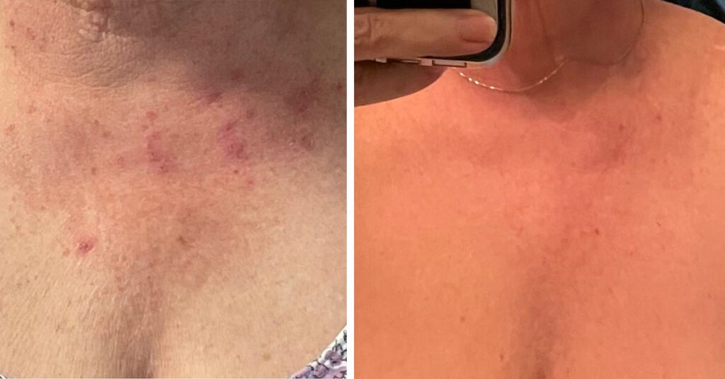Skin Fungus before and after laser treatment