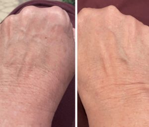 Skin Rejuvenation on Hand Before and After Laser Skin Rejuvenation Treatment
