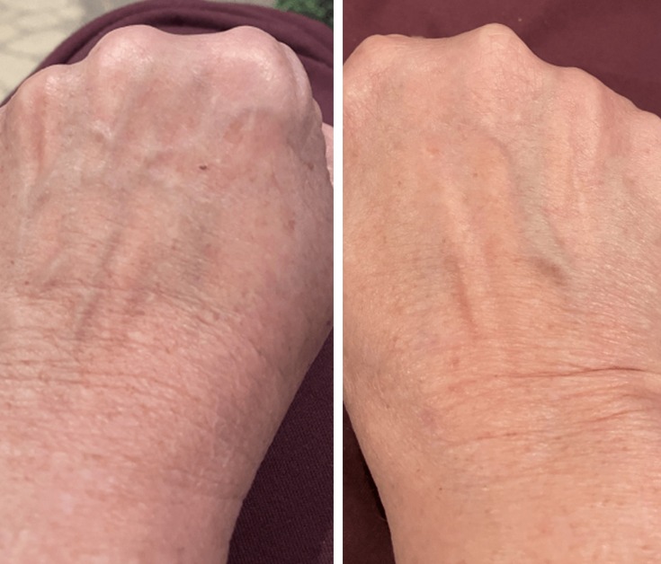Skin Rejuvenation on Hand Before and After Laser Skin Rejuvenation Treatment