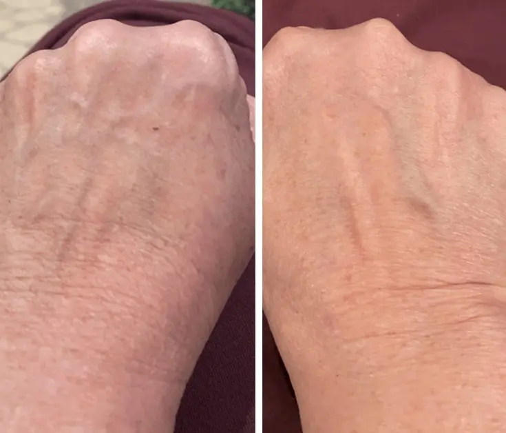 Skin rejuvenation treatment on the hand with a before photo on the left and an after photo on the right