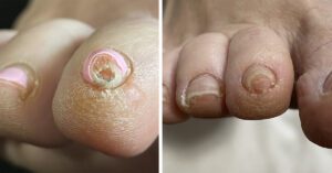 Toe Fungus Before and After 3 laser treatments over the course of 4 weeks