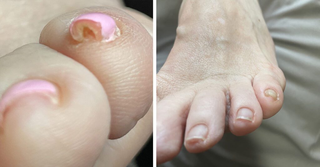 Toe Fungus on a Pinky Toe Before and After 3 Laser Treatments from Laser Beamer Skincare