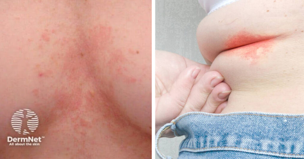 Intertrigo noticed as a rash in skin folds can be treated by Laser Beamer Skincare. Some photos by DermNet