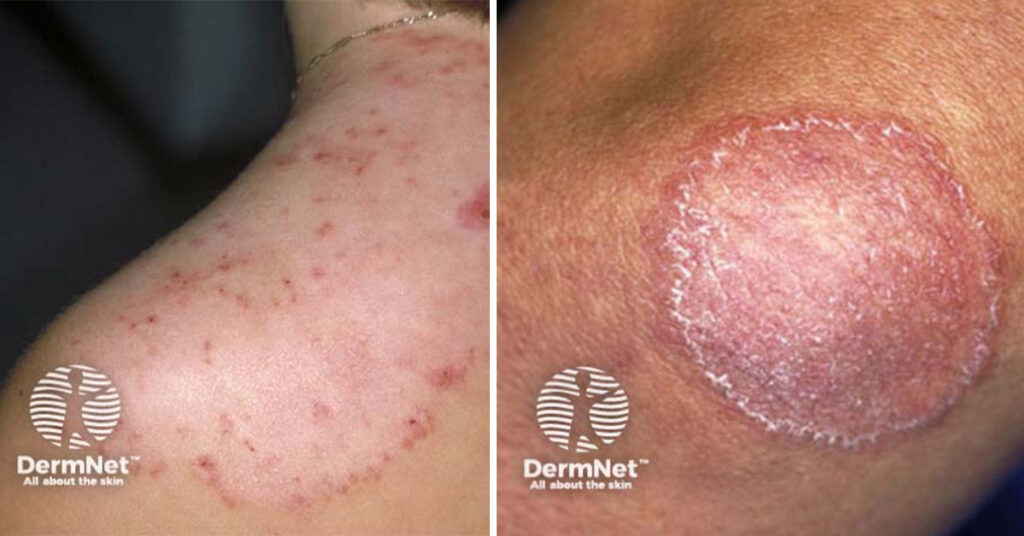 Tinea Corporis commonly referred to as ringworm can be treated by Laser Beamer Skincare photos by DermNet