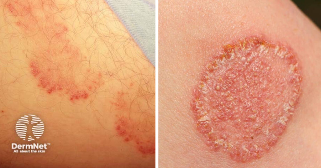 Tinea Cruris commonly known as jock itch can be treated by Laser Beamer Skincare photos by DermNet