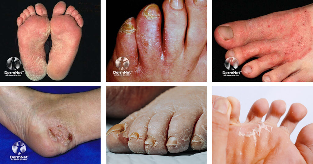 Tinea pedis also known as athletes foot can be treated by Laser Beamer Skincare. Some photos provided by DermNet